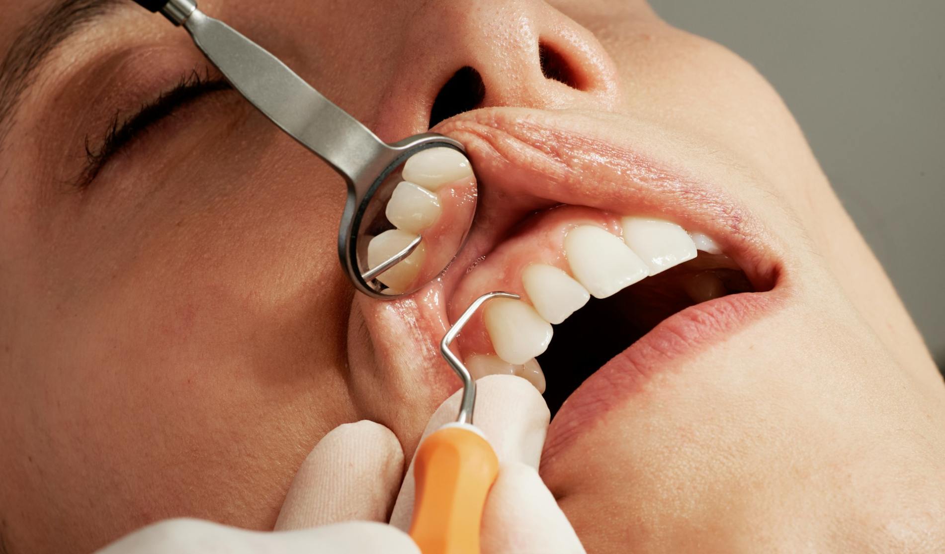 Parulis Fistula: Dental Abscess Treatment and Symptoms