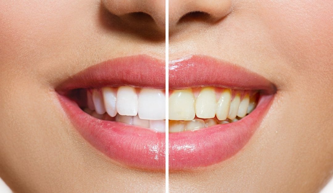 Why Are My Teeth Yellow, Transparent Or Weak?