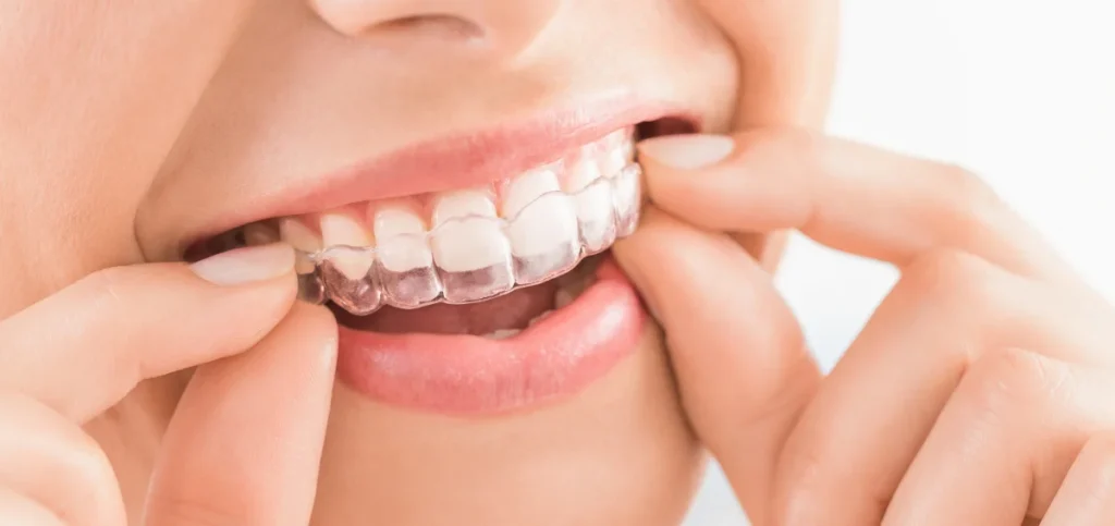 Tips for Invisalign Users