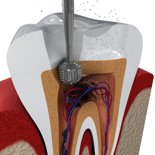 How Much Does a Root Canal Cost in NYC? A Complete Guide